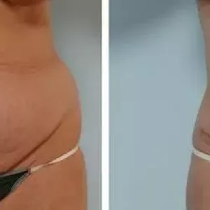 Abdominoplastyka brzucha: zdjęcia przed i po, opinie pacjentów, cechy procedury