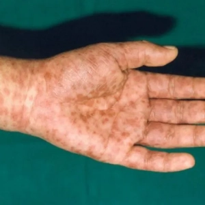 Autoimmunologiczne zapalenie naczyń: zdjęcia, objawy i leczenie