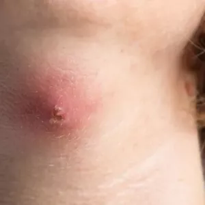 Różnica między czyrakiem a karbunkułem: na czym polega różnica, fot