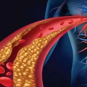 Jak obniżyć cholesterol we krwi u kobiet: środki ludowe i leki. Oczyszczanie organizmu z toksyn