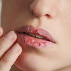 Spierzchnięte usta: co robić, jak z tym walczyć, wskazówki kosmetyczek i dermatologów