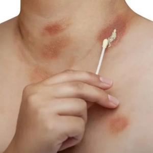 Różowa pityriasis: przyczyny i objawy, leczenie, zapobieganie