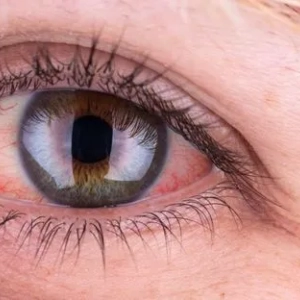 Przyczyny czerwonych oczu u dorosłych i metody leczenia. Urazy i choroby oczu