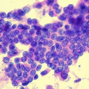 Złośliwy guz tarczycy: objawy, przyczyny, diagnostyka i leczenie